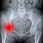 遠絡（えんらく）治療の整骨院の股関節の痛みのページへ