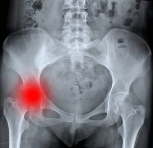 股関節の痛み治療の整骨院「宮谷小交差点前せいこついん」の変形した股関節のレントゲン写真