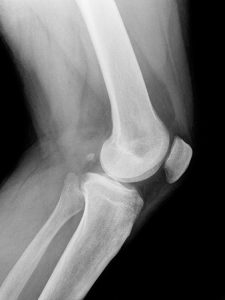 膝の痛み治療の整骨院「宮谷小交差点前せいこついん」の膝のレントゲン写真