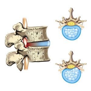 腰椎分離症治療の整骨院「宮谷小交差点前せいこついん」の椎間板ヘルニアのイラスト