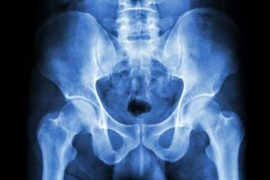 膝の痛み治療の整骨院「宮谷小交差点前せいこついん」の股関節のレントゲン写真