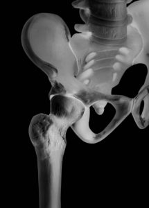 股関節の痛み治療の整骨院「宮谷小交差点前せいこついん」の股関節のレントゲン写真イメージ