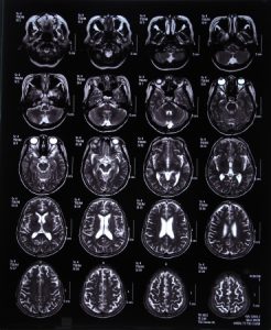 頭痛・片頭痛（偏頭痛）治療の整骨院「宮谷小交差点前せいこついん」の頭痛に関わる脳のMRI写真イメージ